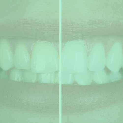 Mondzorg Jade Mondhygiënist Oss tandenbleken tanden bleken