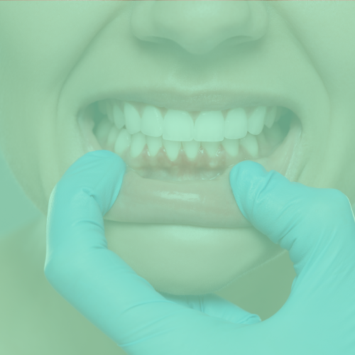 Mondzorg Jade Mondhygiënist Oss parodontologie tandvlees problemen